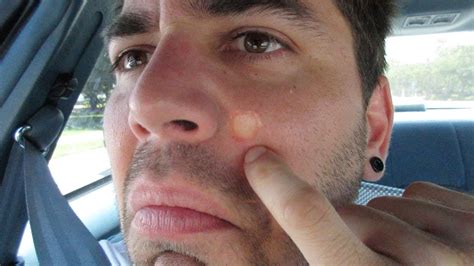Giant Pimple On My Face 61014 Day 1867 Youtube