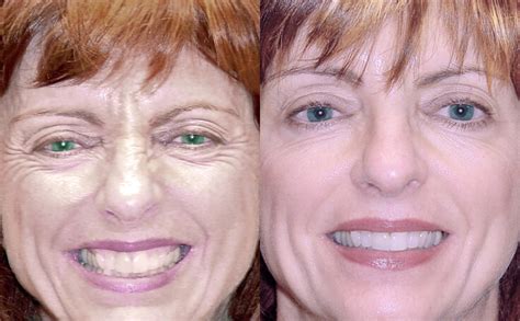 Before And After Botox Injections Around The Eyes Dr Rodriguez