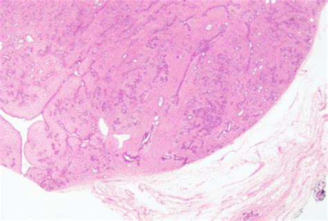 Ductal Carcinoma In Situ Within Fibroadenoma Of The Breast A Case