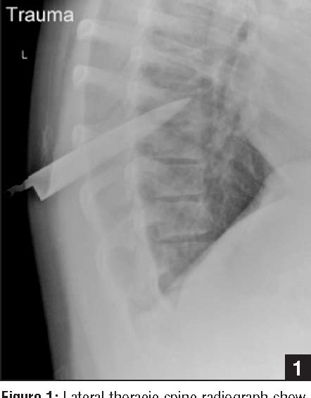 Figure 1 From Intraspinal Penetrating Stab Injury To The Middle