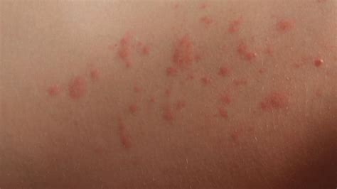 I've got an itchy rash all over my chest. What's that rash?: with pictures | Queensland Health