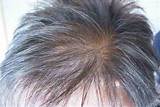 Treatment For Dry Brittle Thin Hair