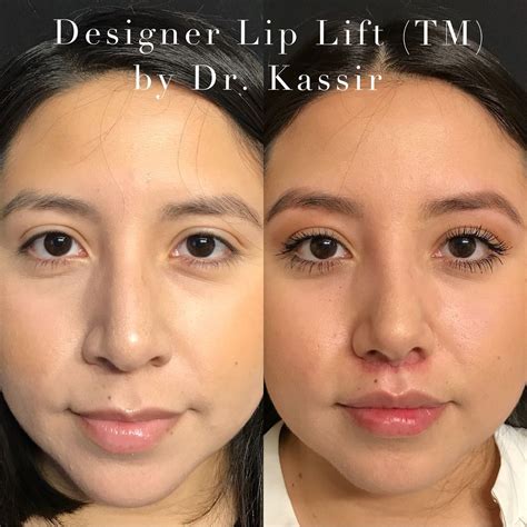 Please Swipe ⬅️left To See All The Photos And Videos For Designer 👩‍🎨 Lip Lift®️by Dr Kassir