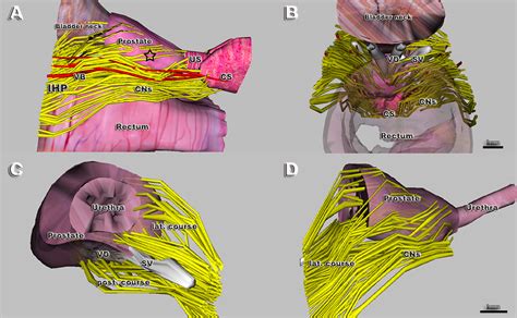 Tridimensional Computer Assisted Anatomic Dissection Of Posterolateral