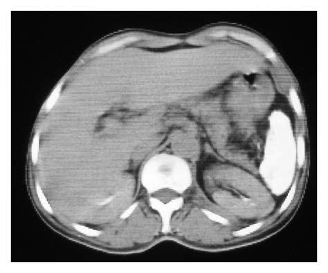 Abdominal Ct Scan Showing A Small Atrophied And Calcified Spleen