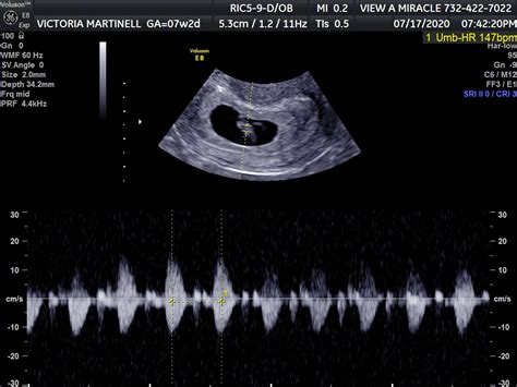 Week By Week Ultrasound Gallery 2d 3d 5d Visual Pictures