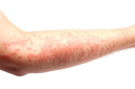 Why Rashes In Covid 19 Patients Should Not Be Ignored Health24
