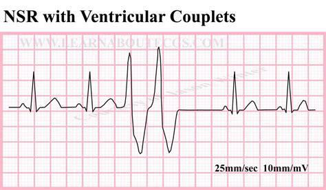 Nsr With Ventricular Couplets By Electrocardiology On Etsy
