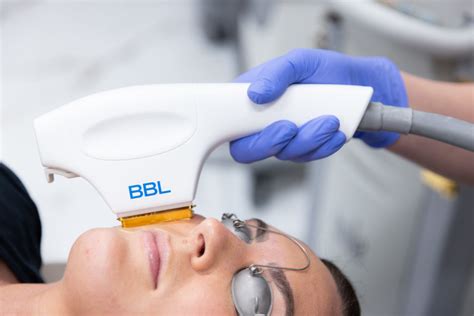 Everything You Need To Know About An Ipl Photofacial In Albany Or