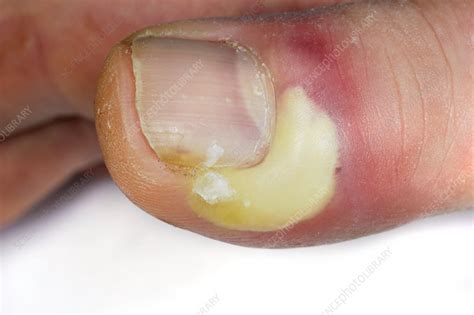 Abscess On The Thumb Stock Image C0115488 Science Photo Library