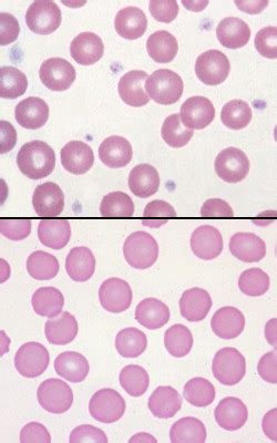 Normal And Abnormal Platelet Count Eclinpath
