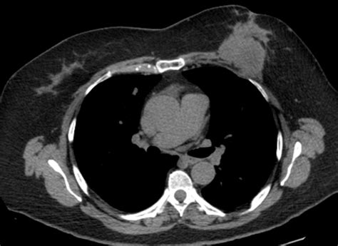 Chest Wall Lumps Rib Injury Clinic