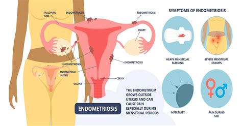 Endometriosis Diagnosis And Treatment Mayo Clinic Hot Sex Picture