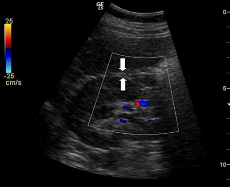 Ultrasound Assessed Perirenal Fat Is Related To Increased Ophthalmic