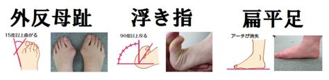 Doujin music | 同人音楽 8 янв 2015 в 18:38. 変形性膝関節症と外反母趾・指上げ足(浮き指)の関係 | ひざの ...