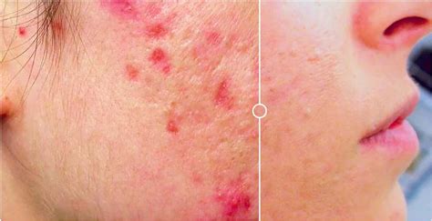Acne Scarring Ailesbury Clinic