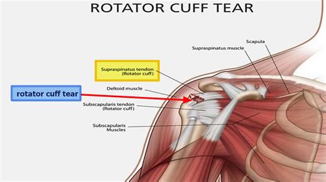 Rotator Cuff Tear Symptoms Causes Diagnosis Prognosis And Treatment