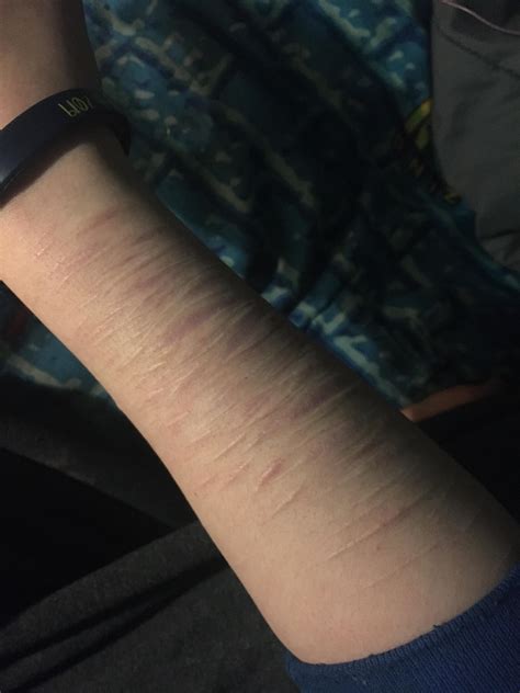 Tw My Scars On My Arm From A Year Or More Ago Im Much Much Better