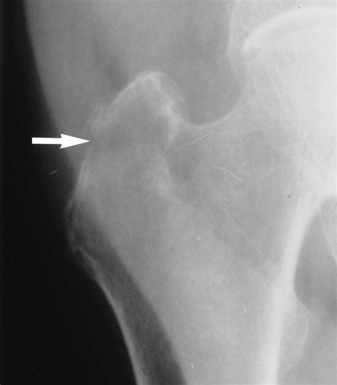 Imaging Features Of Avulsion Injuries Radiographics
