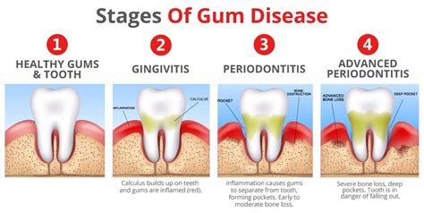 The Stages Of Periodontal Disease Upper East Side New York Ny The Center For High Tech Dentistry