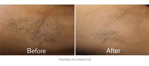 Laser Hair Removal Nyc Safe Effective Permanent Solutions