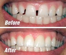 When you think of a perfect smile, do you think of a straight, white set of teeth? Teeth Gap Bands