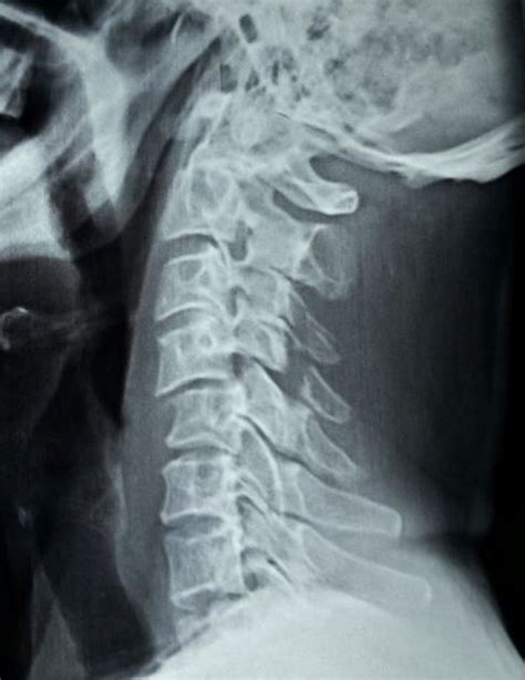 Cervical Injury Xrays Bone And Spine