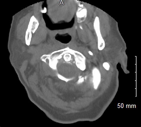 Cureus Crowned Dens Syndrome Masquerading As Meningitis