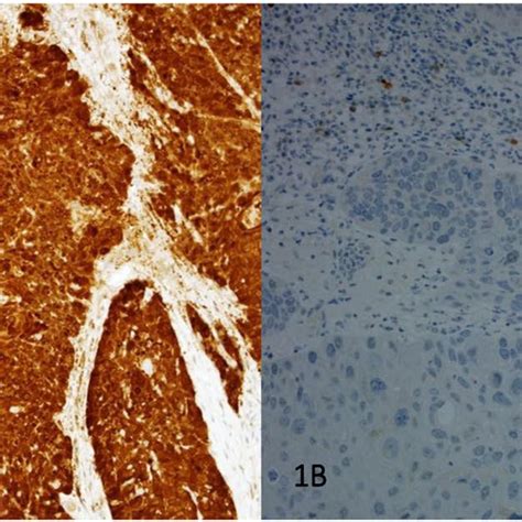 Examples Of Ihc Staining Of A P16 Positive Patient 1a And Of A P16