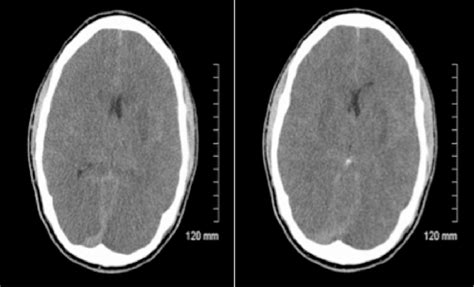 Anoxic Brain Injury Ct And Mri Patterns Quick Pictoral Quide For