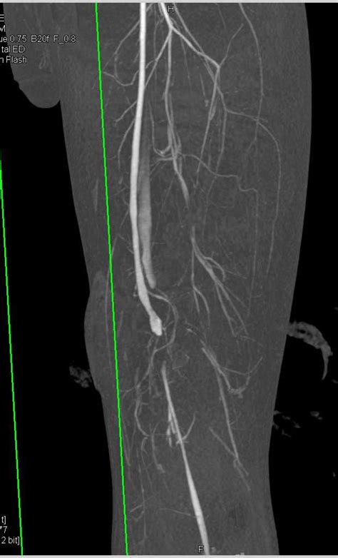 Cta With Laceration Superficial Femoral Artery Sfa With Mid Thigh