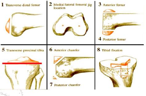 Total Knee Replacement Surgery Types Treatment And Recovery Meril