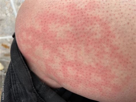Hives Heat Rash Eai Erythema Ab Igne Allergy Reaction On Knee Close Up