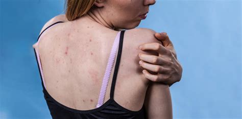 Amazing Treatments For Keratosis Pilaris You Should Know