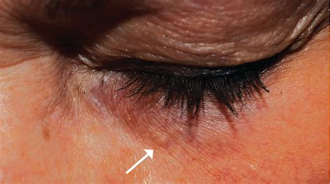 58 Year Old Female With Asymptomatic Lesion Around Eyelid The Doctor