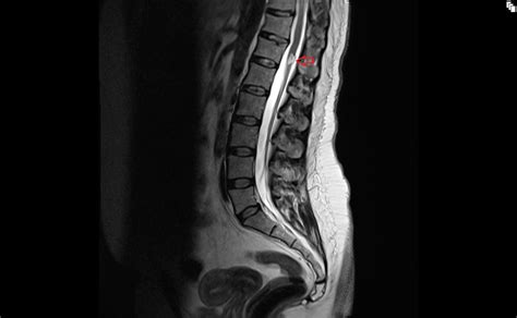 Lipoma Of The Conus Medullaris Mri Radiology Article On Spinal Lipomas