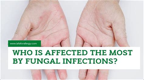 Everything You Need To Know About Fungal Infections 57 Off