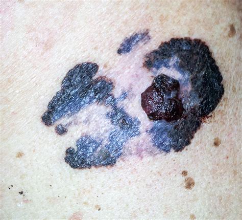 Melanoma Stages Take These Precautions To Avoid Skin Cancer