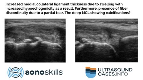 This Article Describes The Reliability Of Msk Ultrasound In Medial