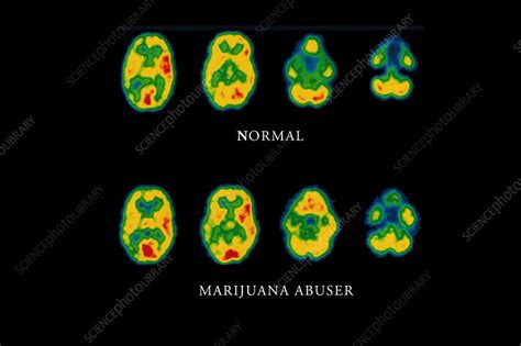 Cannabis Brain Scans Stock Image M3710044 Science Photo Library