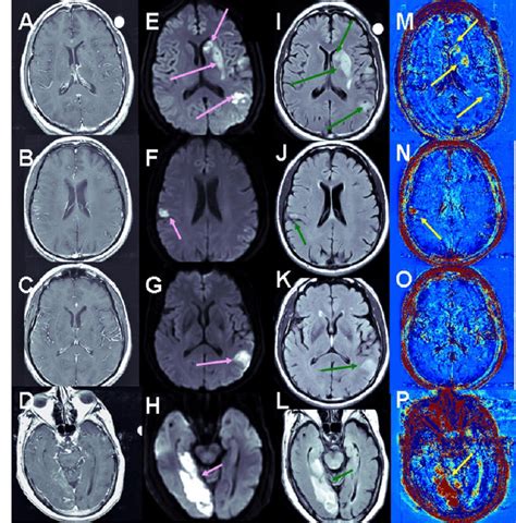 Examples Of Bbb Maps In Ischemic Stroke Contrast Enhanced T1 Mri