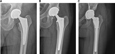 Detecting Total Hip Replacement Prosthesis Design On Plain Radiographs Using Deep Convolutional