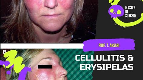 Everything You Need To Know About Cellulitis And Erysipelas Youtube