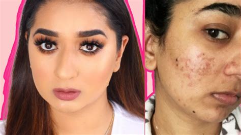 How To Cover Acne Scars Simple Makeup Transformation Routine