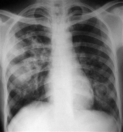 Aspergilosis Chest X Ray Revealed Bilateral Infiltrates And Ill Defined