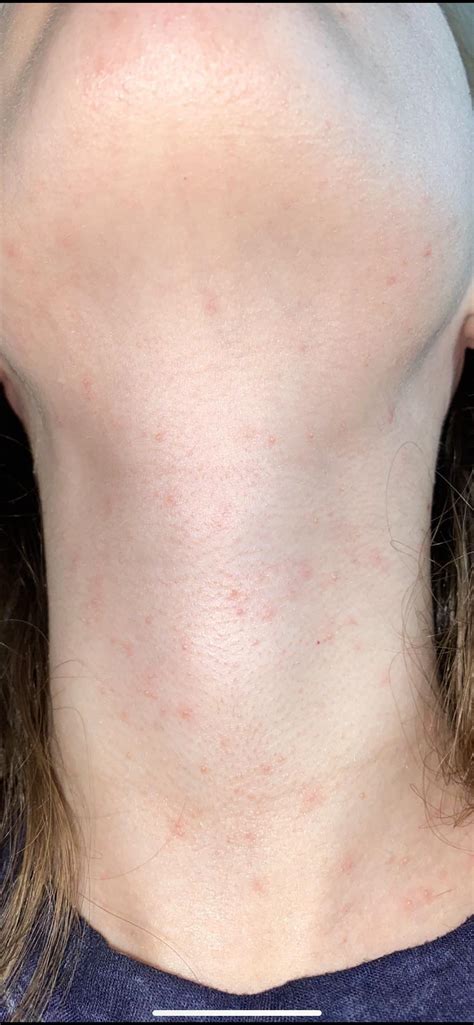 I Have This Rash On My Neck Chest And Shoulders That Wont Go