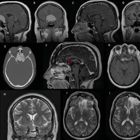 A Sagittal Mri Brain Images T1 With Contrast 6 Month Download
