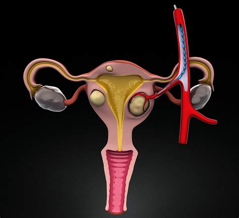 Uterine Fibroids Treatment Photograph By Jose Antonio PeÑas Pixels