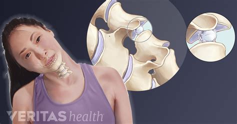 Causes Of Neck Cracking And Grinding Sounds