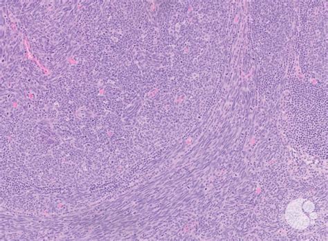 Lymph Node With Metastatic Spindle Cell Melanoma